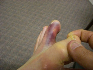 "jacked up" toe.jpg