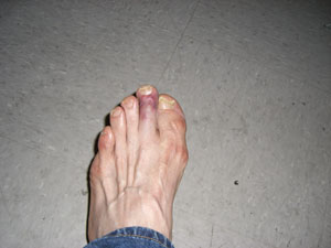 "jacked up toe2".jpg